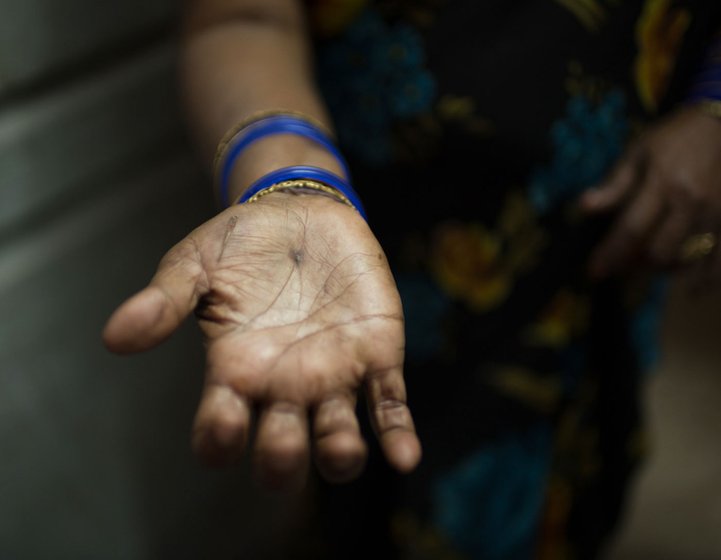 A woman holding out her hand to show the injuries on her palm.