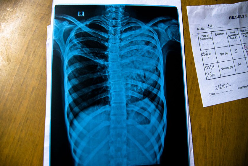 An X-ray (left) is the main diagnostic tool for detecting pulmonary tuberculosis. Based on the X-ray reading, a doctor may recommend a sputum test.