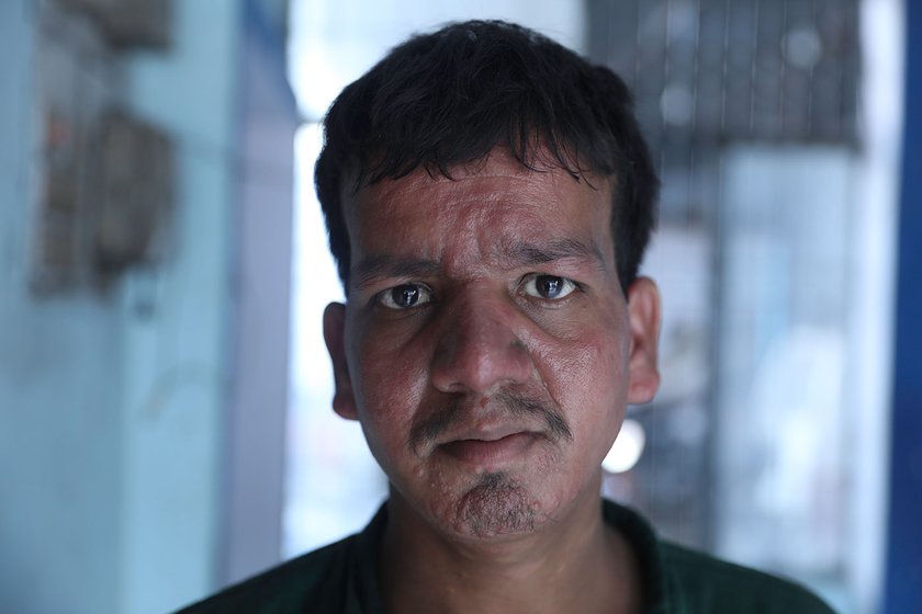 Asmat Ali, 19 has lived with PKDL for 9 years but treatment is not on his list of priorities
