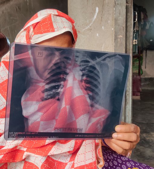 Shahinur Bibi holds up her X-ray showing her lung ailments.