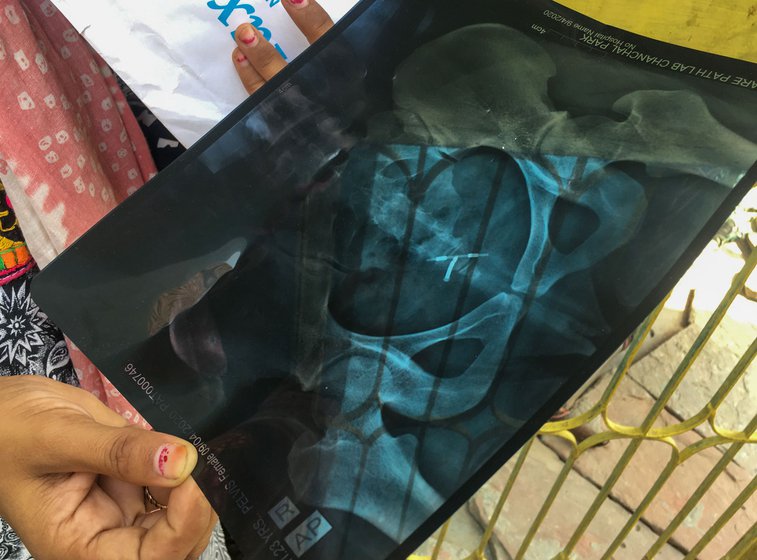 Deepa showing a pelvic region X-ray report to ASHA worker Sushila Devi, which, after months, finally located the copper-T
