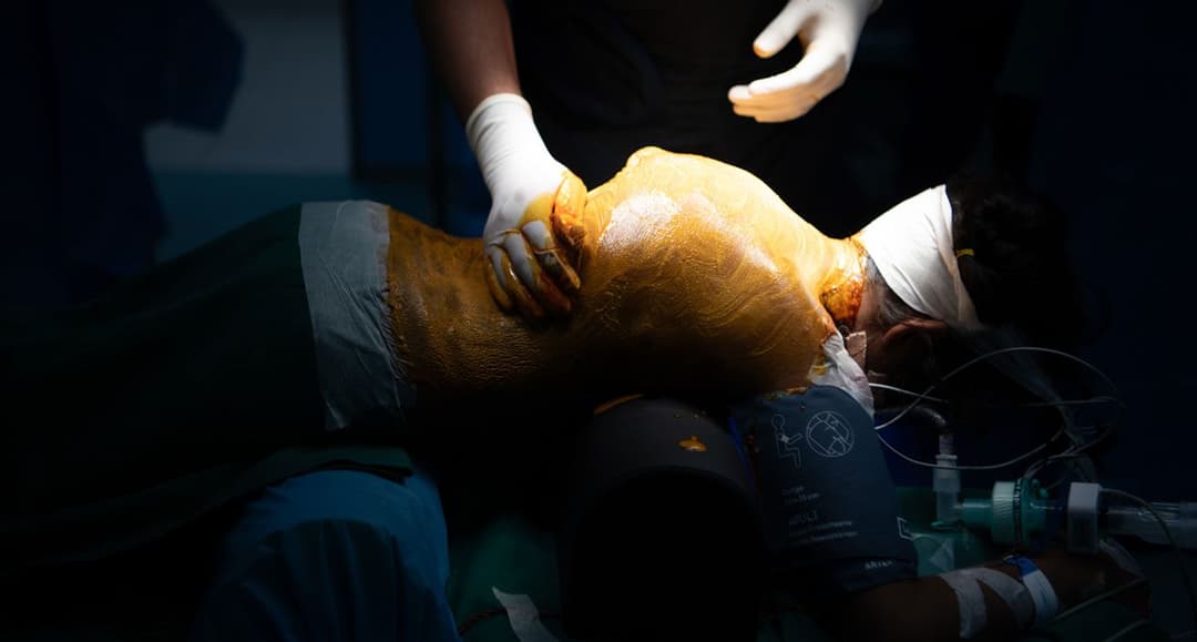 Scoliosis is bending young India's spine