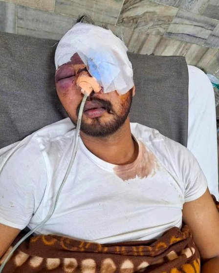 Left: Davinder Singh Bhangu went to the Shambhu border with his friends to join the farmers’ protest. Within an hour of their arrival, he was struck in his left eye by a pellet fired by the forces and had to be rushed to the hospital.