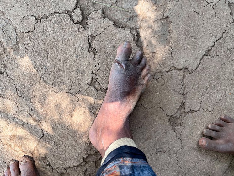 Right: Ungya's wife, Badhibai's toe was almost sliced off when a hatchet she was using to chop firewood fell on her leg. There is no clinic nearby to treat the gash