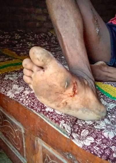 Sudhir Kosare recuperating from a wild boar attack that happened in July 2023. H e is with his wife, Darshana, and mother, Shashikala, in his house in Kawathi village of Saoli tehsil . Sudhir suffered many injuries including a deep gash (right) in his right foot