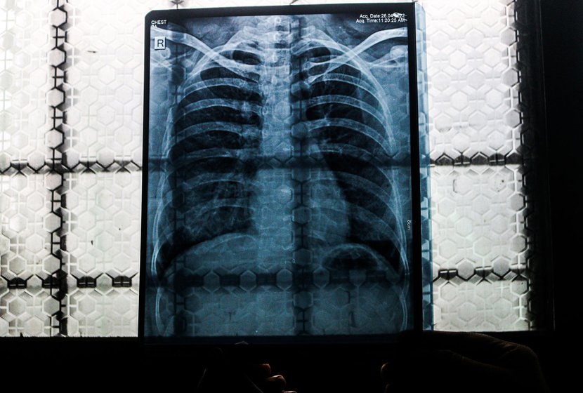 ASHA worker Shubhangi Kamble’s X-ray report. In April 2022, she was diagnosed with pneumonia and also moderate anaemia