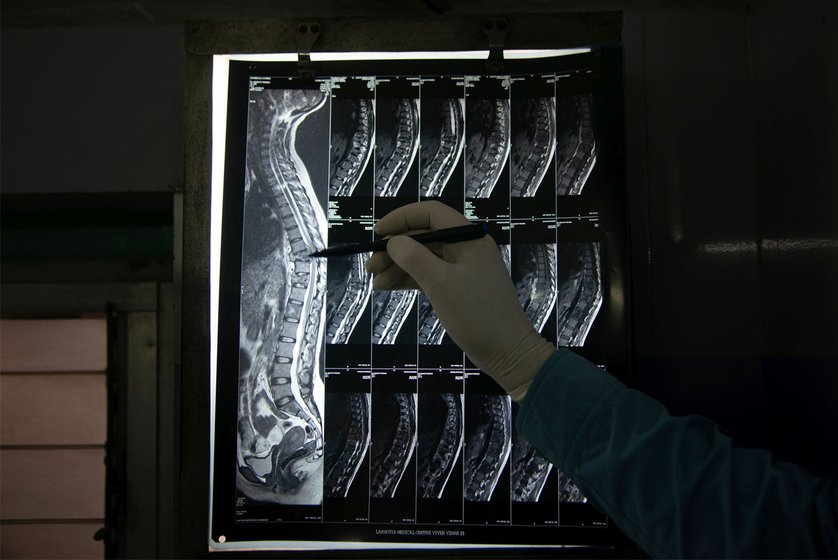 An MRI scan (right) of a 24-year-old patient  shows tuberculosis of the spine (Pott’s disease) presenting as compression fractures