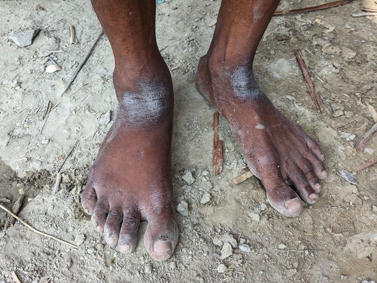 Years of climbing the rugged trunk of palm trees have left dark calluses on his hands and feet.