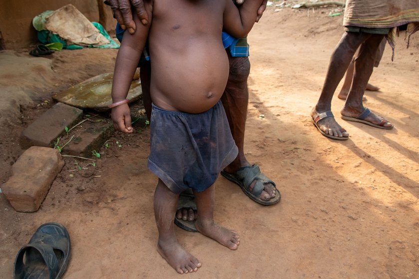 A child (right) exhibiting symptoms of malnutrition