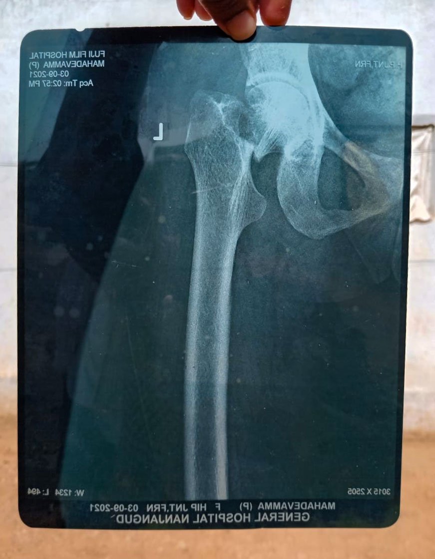 Left: Mahadevamma's x-ray showing her fracture.