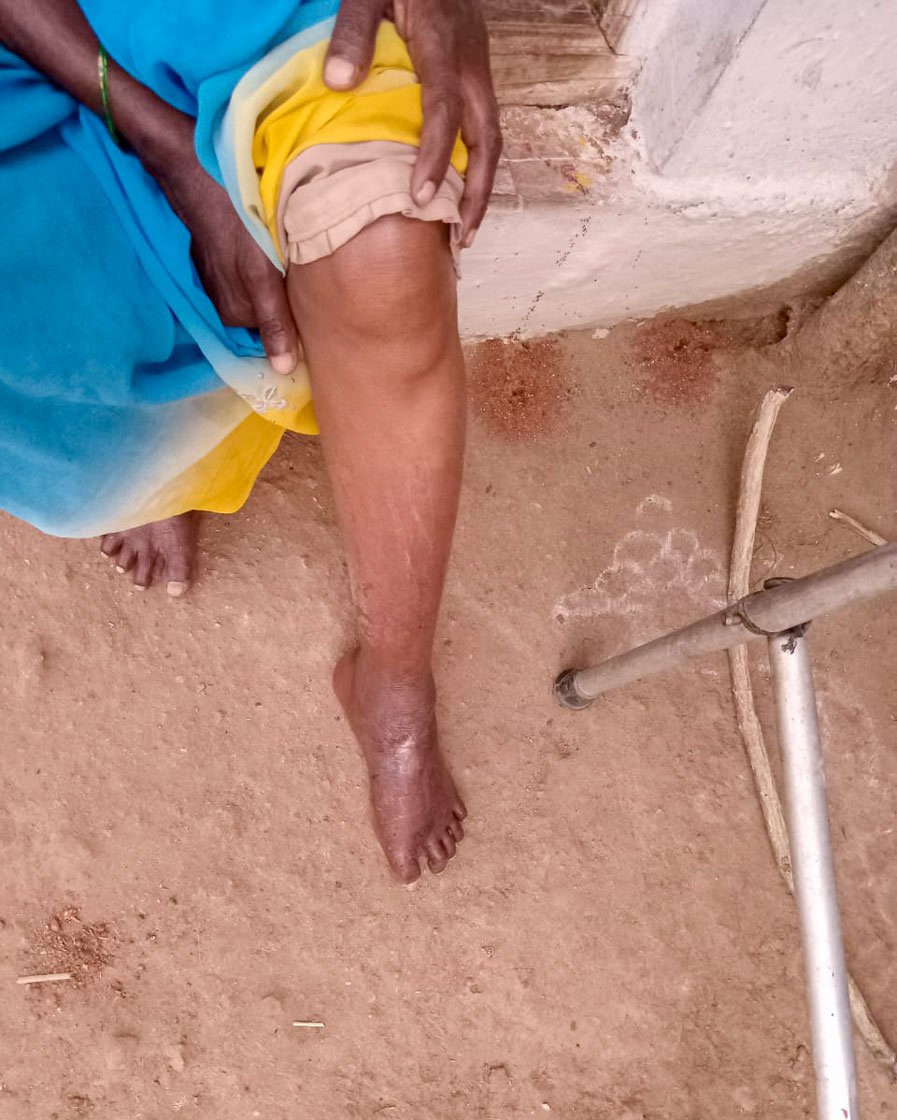 Right: Her wounded foot where the splint pressed down.  Mahadevamma can no longer use this foot while walking