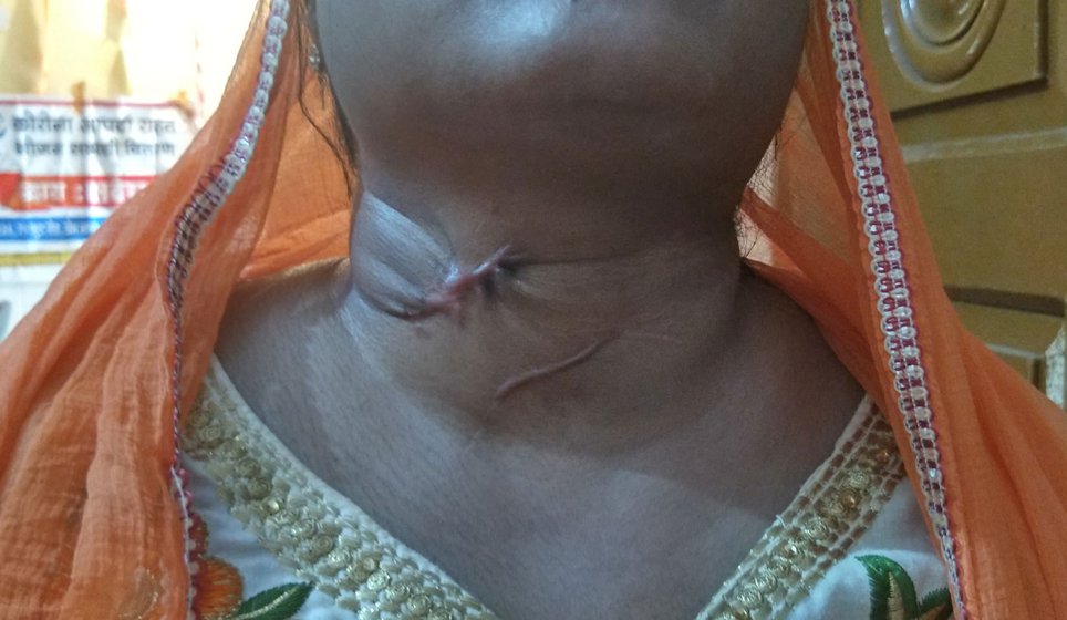 Pinki was left with a scar after a client-turned-lover tried to slit her throat. She didn't seek medical attention for fear of bringing on a police case.