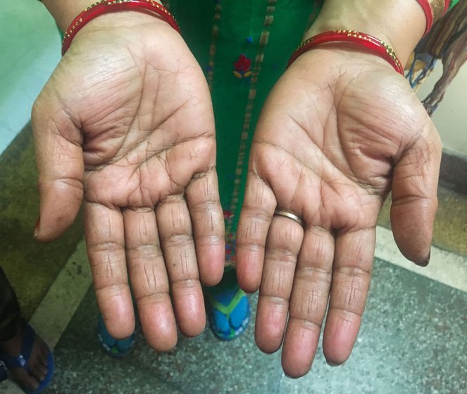 Kanta's work-worn hand from toiling in the fields and tending to the family's buffaloes. When her third child was also a girl, she started taking contraceptive pills