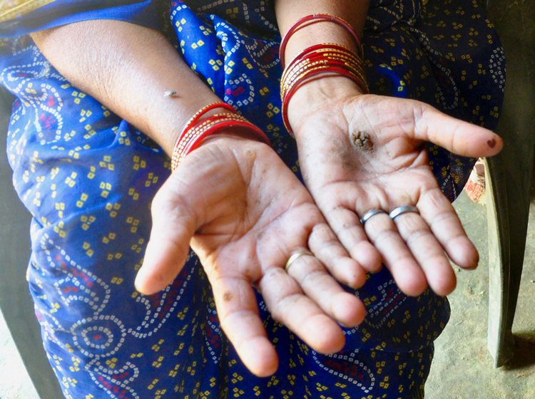 Kiran Devi, who lost her husband in 2016, has hardened and discoloured spots on her palms, a sign of arsenic poisoning. 'I know it’s the water...' she says