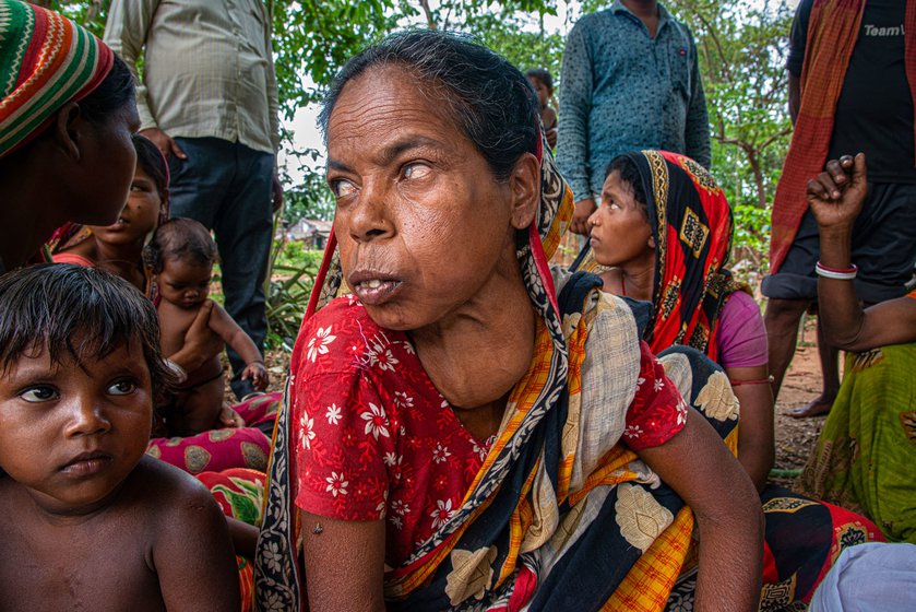 Right: Behula Nayak is deficient in iodine and has developed goitre, a common occurance among Sabar women in Benashuli