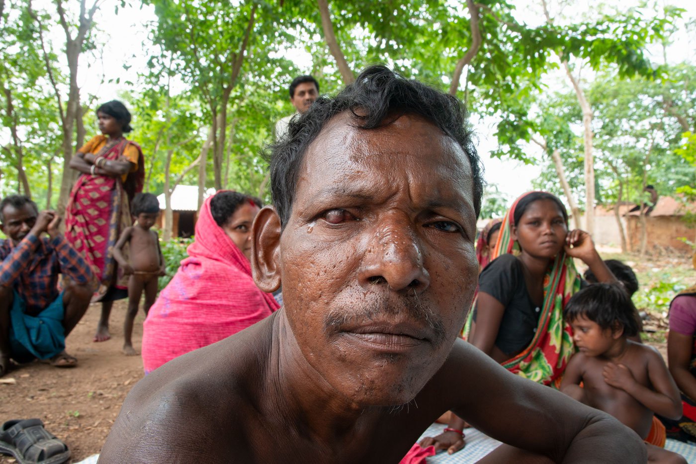 Madan Bhakta of Tapoban village has a rare eye disease. A local unlicensed doctor treated him wrongly, and as a result Bhakta lost his vision