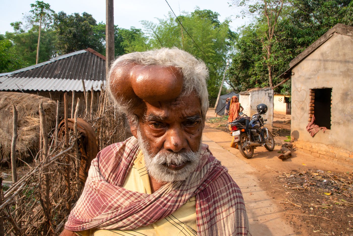 Konda Bhakta from Tapoban shows his tumour. 'First it was a small tumour. I ignored it. Then it became big. I wanted to go to the hospital but could not as they are located very far in Jhargram town. I do not have that much money, so I never had a proper treatment'